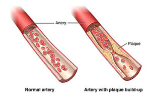 rendering of atherosclerosis - buildup of fatty plaque in arteries